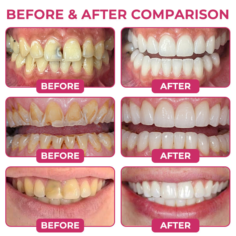 🦷 Rolimey® DenPerm Cavity-Repair Natural Enamel Filling Gel