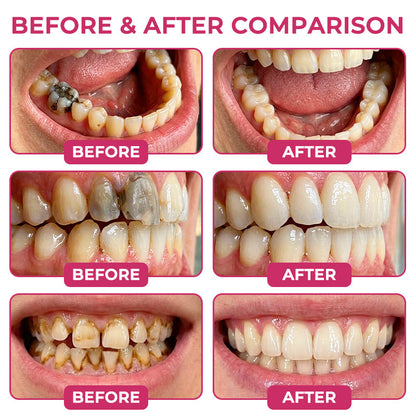 🦷 Rolimey® DenPerm Cavity-Repair Natural Enamel Filling Gel